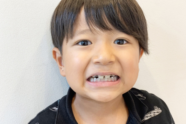 現代人の子供たちの歯は変化している？